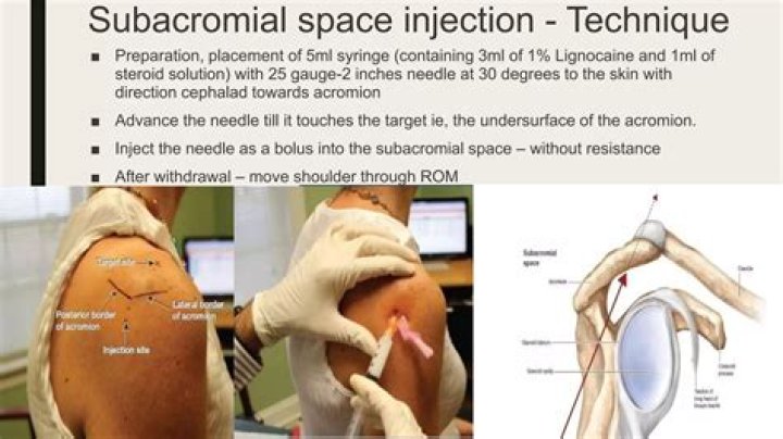 Injection in subacromial space?