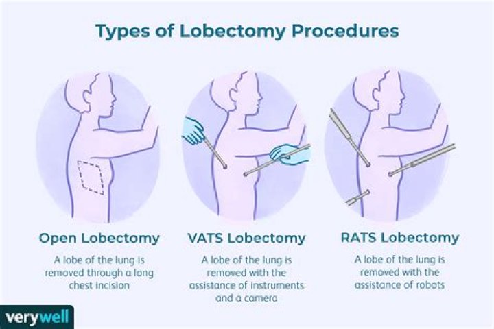 Is a lobectomy major surgery?