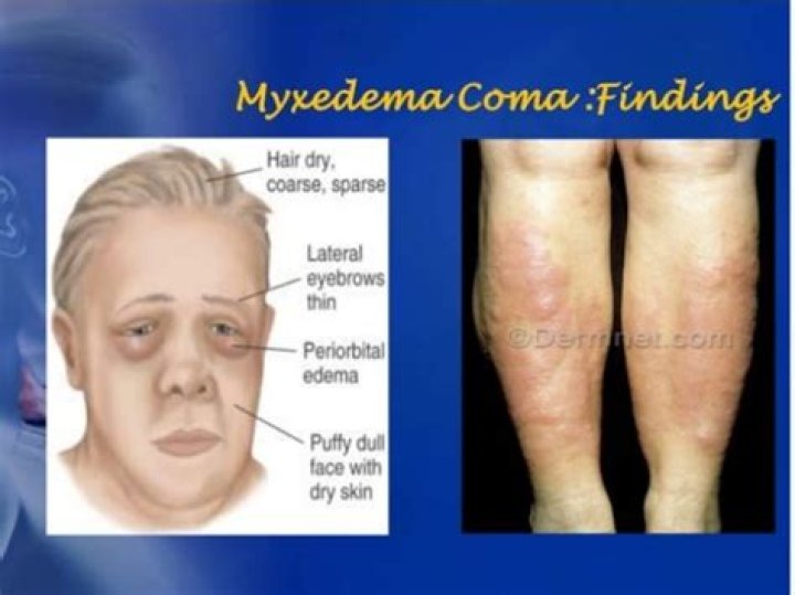 Is a myxedema coma?