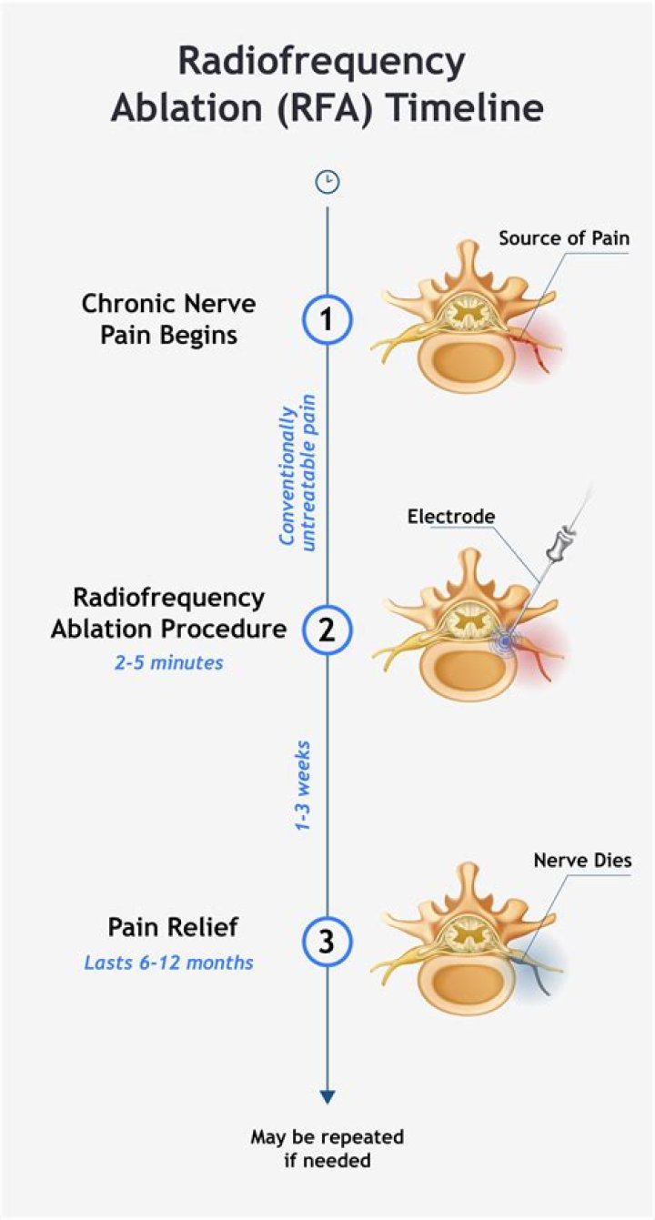 Is a rhizotomy the same as an radiofrequency ablation?