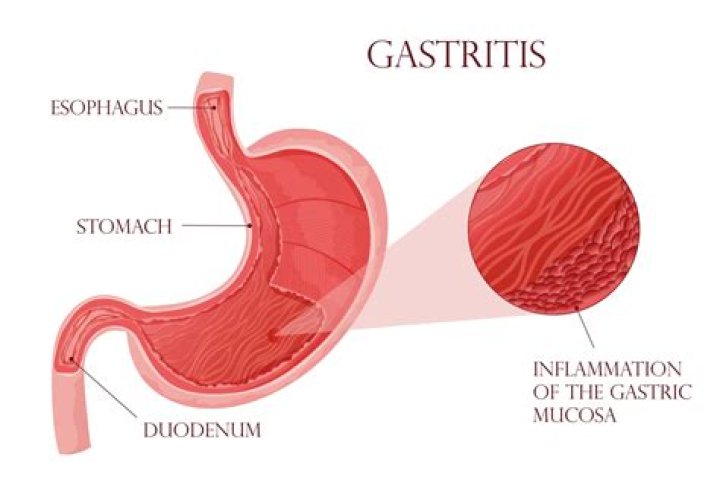 Is atrophic gastritis and autoimmune disease?