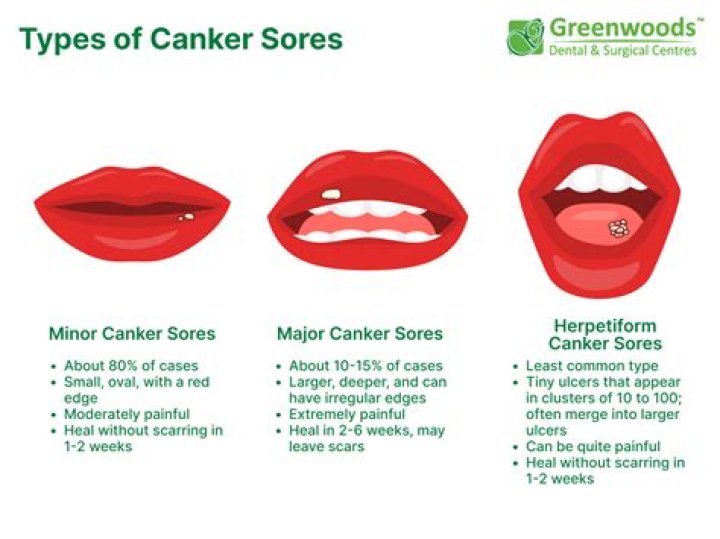 Is canker sore contagious?