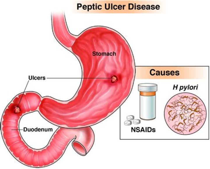 Is garlic good for peptic ulcer?