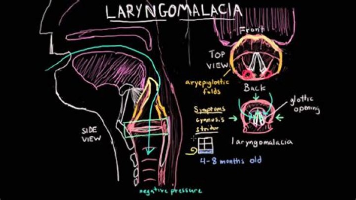 Is laryngomalacia life threatening?
