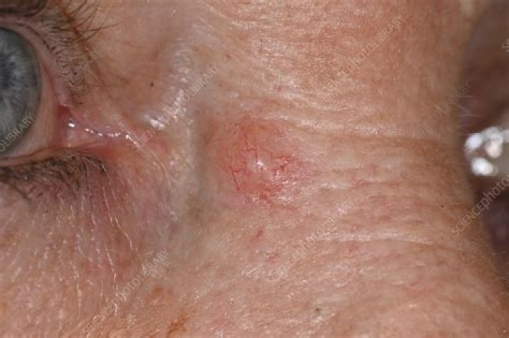 Is nodular basal cell carcinoma dangerous?