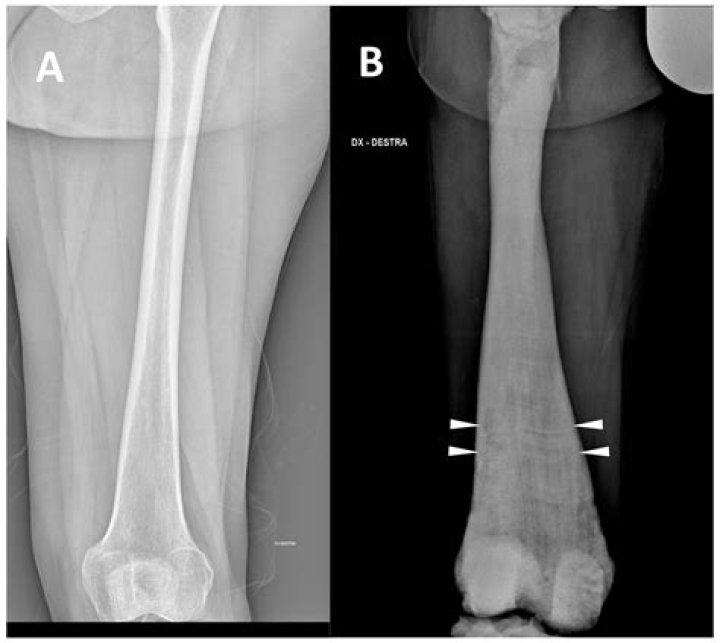 Is osteopetrosis a genetic disorder?