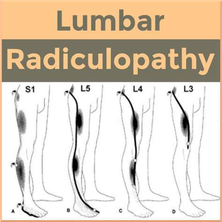 Is radiculitis the same as radiculopathy?