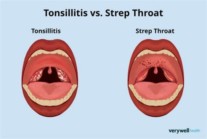 Is strep b symptoms?