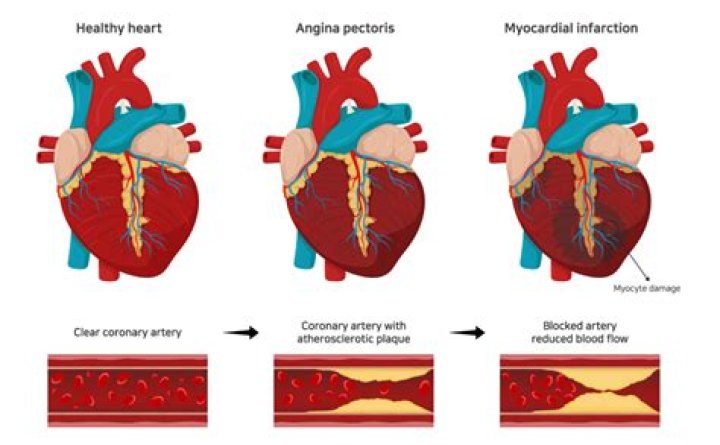 Is stroke a heart disease?