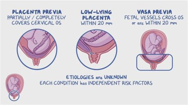 Is succenturiate placenta high risk?