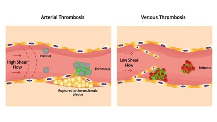 Is thrombosis a stroke?