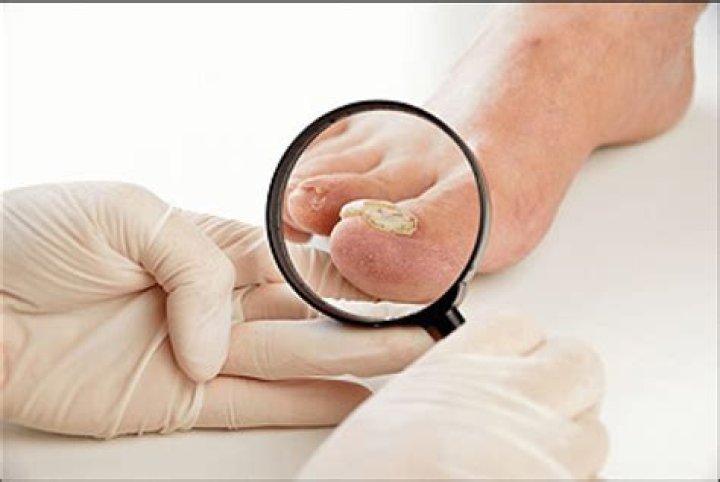 Is toenail fungus contagious?