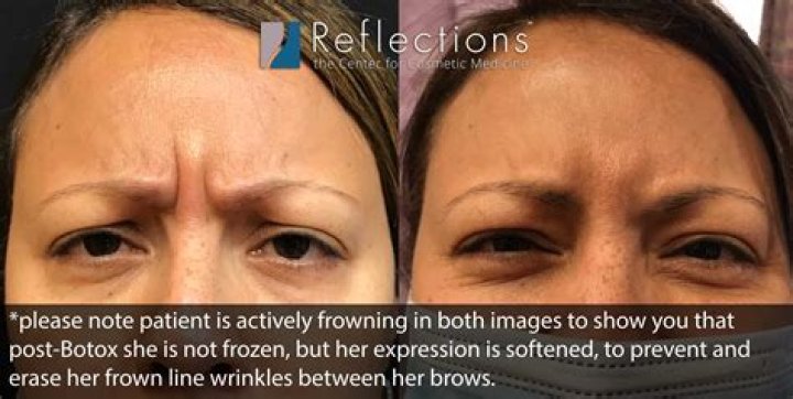 Should i frown after botox?