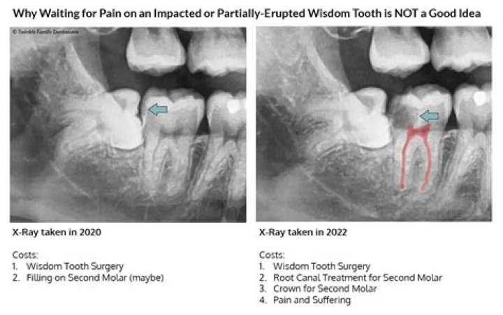Should i remove decayed wisdom tooth?