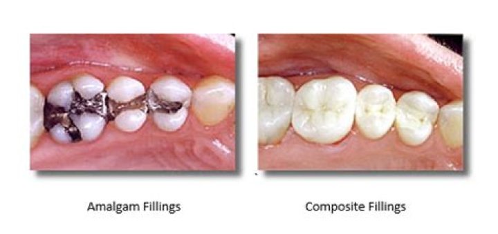 Should i remove my amalgam fillings?