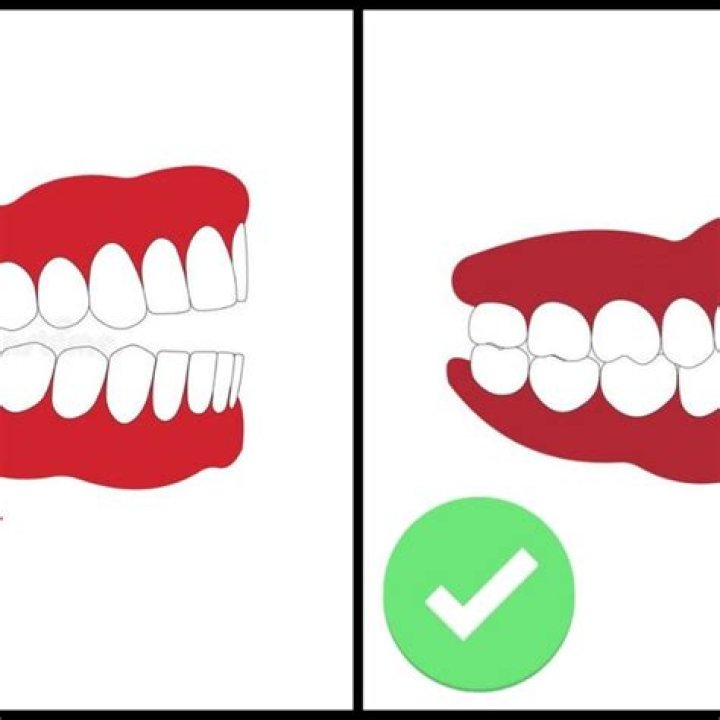 Should teeth touch each other?