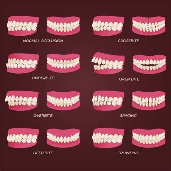 Should you show bottom teeth when smiling?