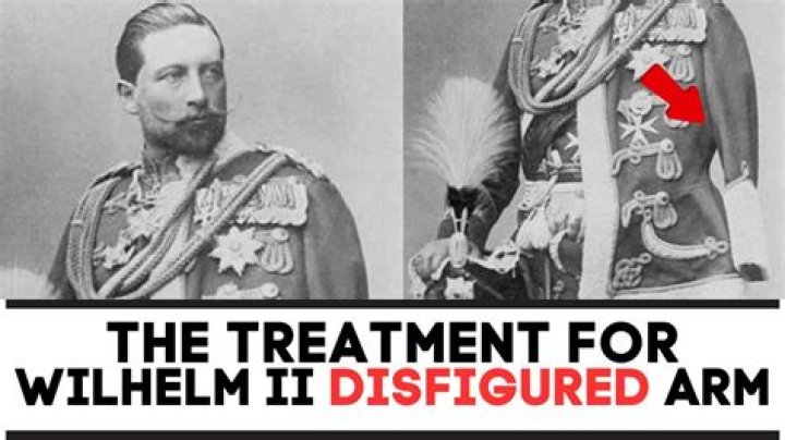 Was wilhelm ii disabled?