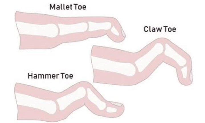 What are clawed toes?