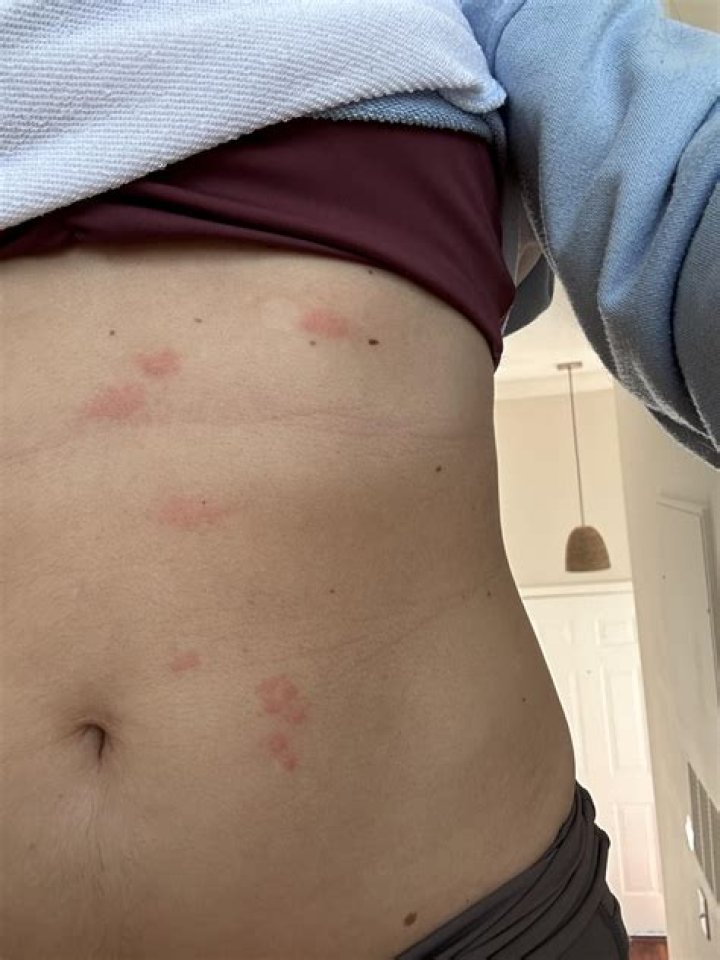 What are itchy welts?