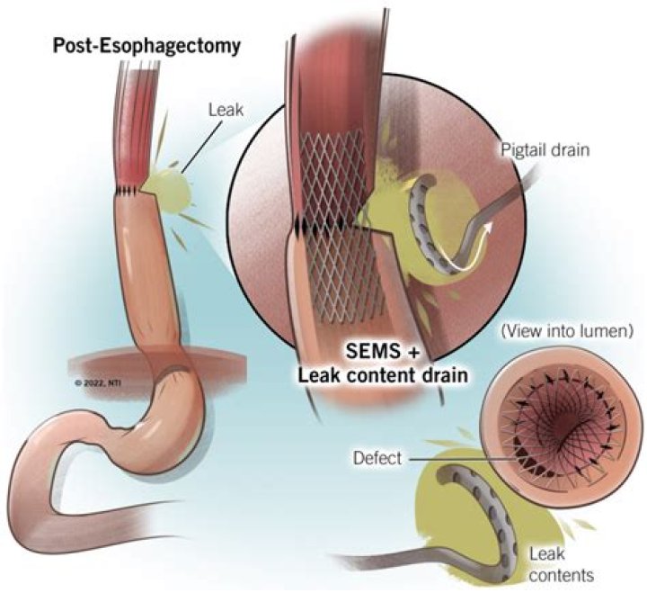 What are the symptoms of an anastomotic leak?