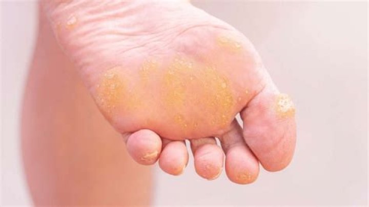 What causes calluses on bottom of feet?