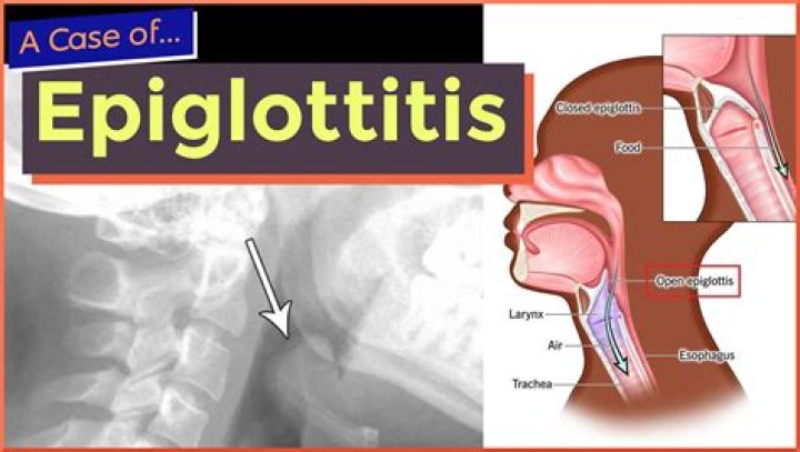 What causes epiglottitis in infants?