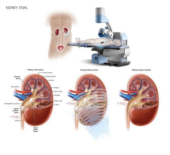 What do nephropexy mean?