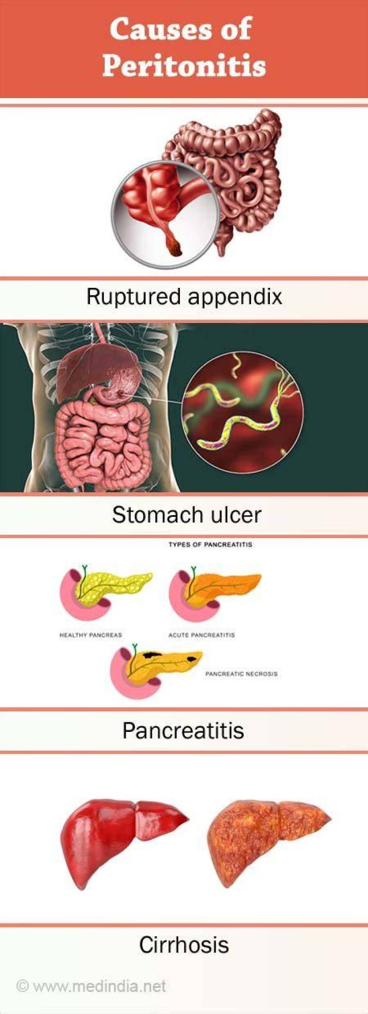 What does a peritonitic abdomen feel like?