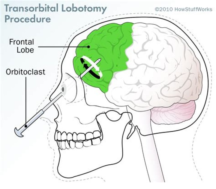 What does a prefrontal lobotomy do?