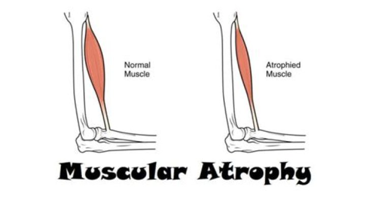 What does atrophic mean in medical terms?