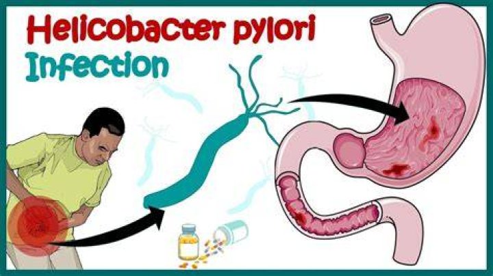 What does helicobacter pylori cause?