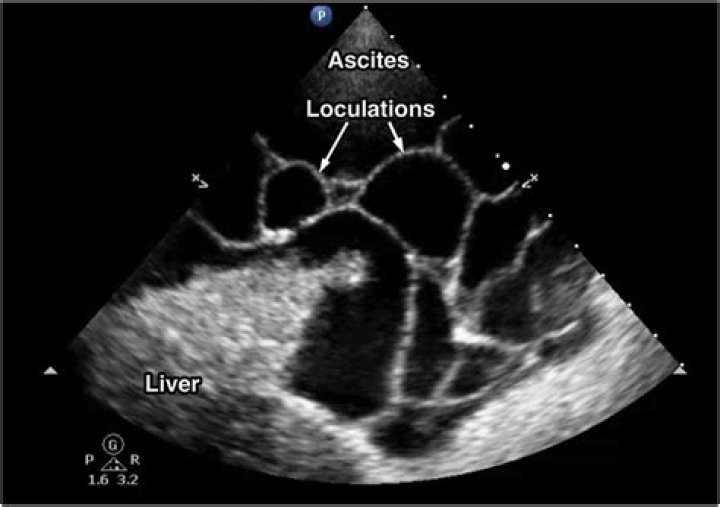 What does loculated cyst mean?