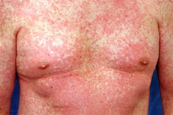 What does morbilliform rash mean?