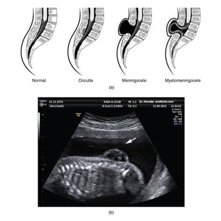 What does myelocystocele mean?