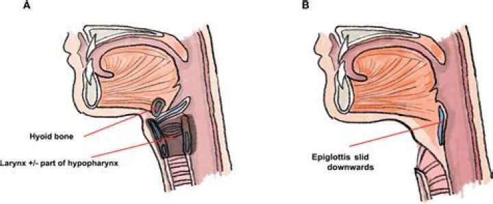 What does pharyngectomy mean?