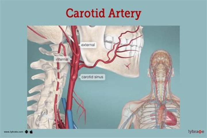 What is a carotid?