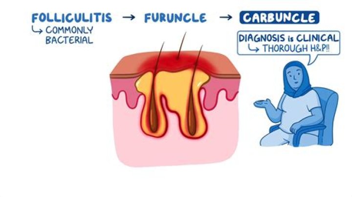 What is a furuncle cyst?