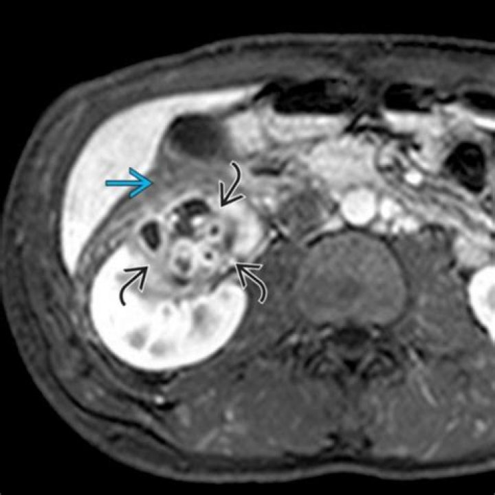 What is a myelolipoma mean?