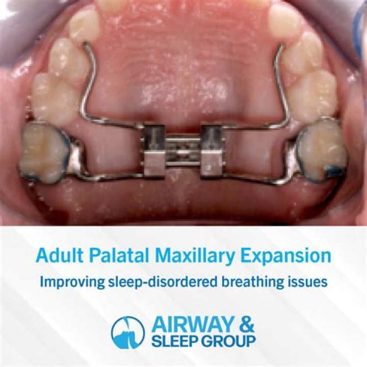 What is a palatal?