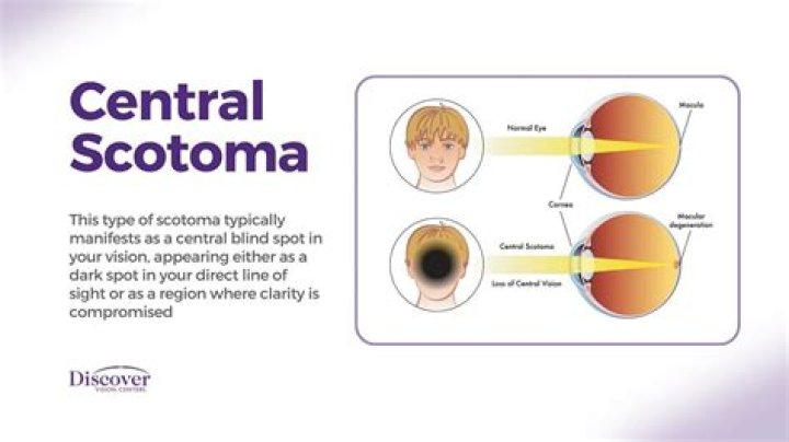 What is a scotoma?