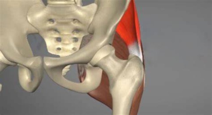 What is abductor tendonitis?
