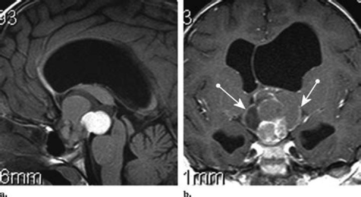 What is adamantinomatous craniopharyngioma?