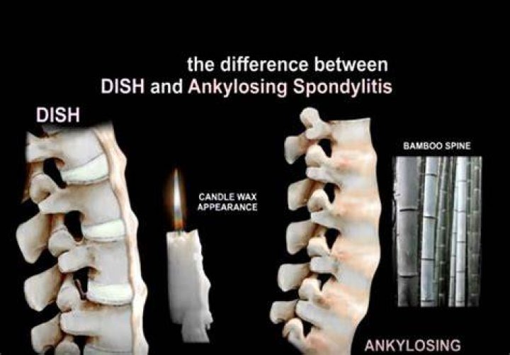 What is ankylosing hyperostosis?