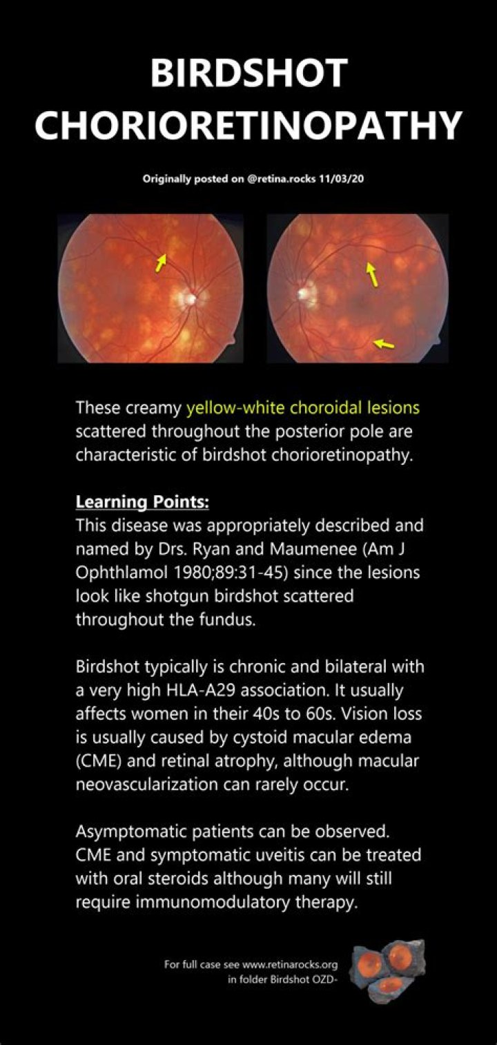 What is birdshot chorioretinitis?