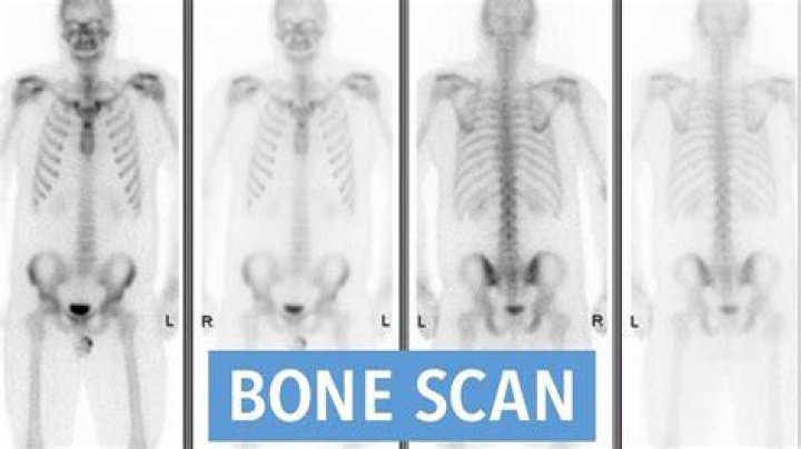 What is bone scintigraphy?