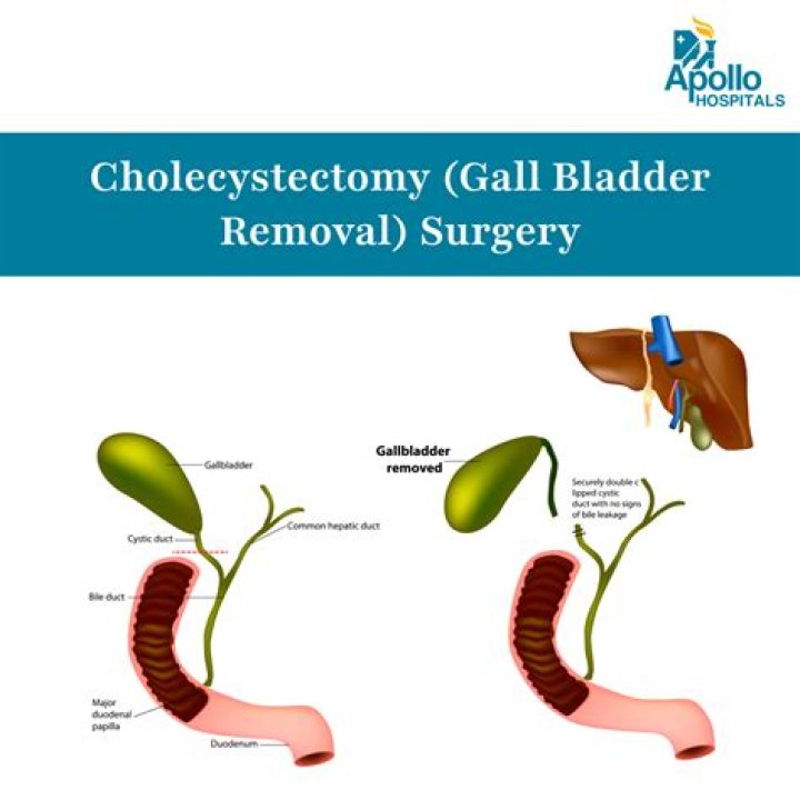 What is cholecystectomy with cholangiography?