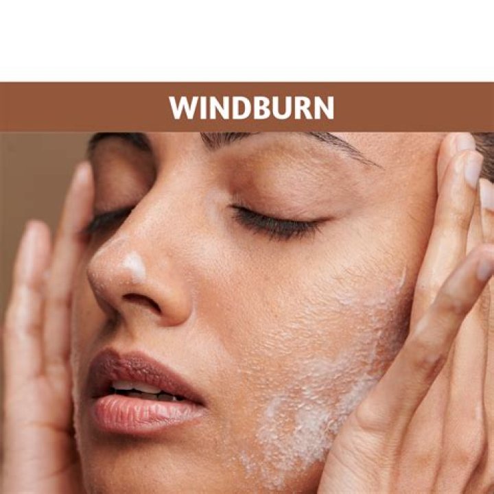 What is good for wind chapped face?