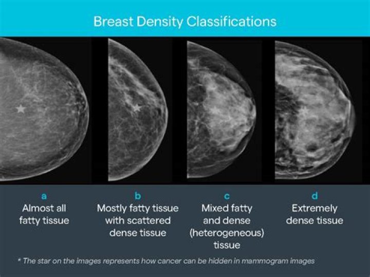 What is mammographic breast density?