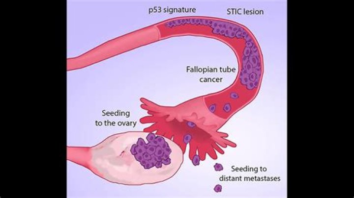 What is mullerian cancer?